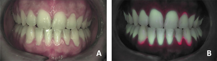 Mise en évidence de la plaque dentaire chez un participant à l'étude