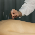 L’acupuncture