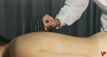 Une séance d'acupuncture pour arrêter de fumer.