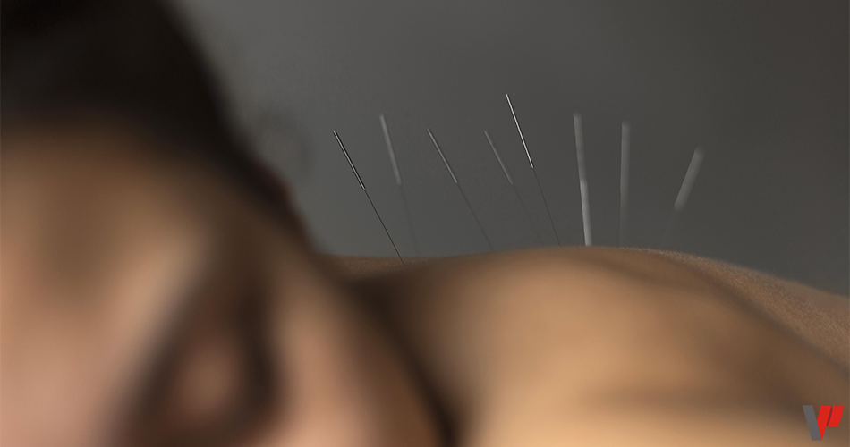 Des aiguilles enfoncées dans le dos d'une femme lors d'une séance d'acupuncture